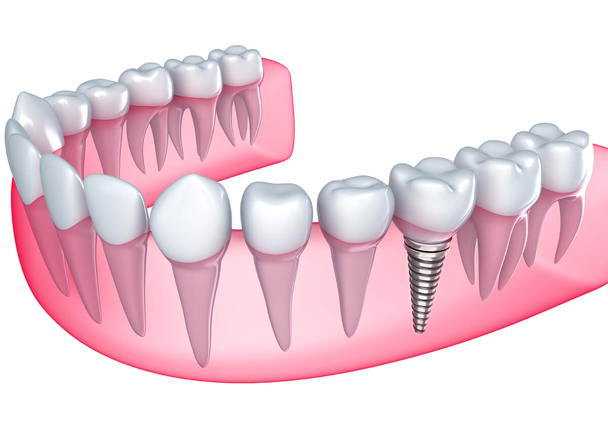 Mini implants: a cost-effective alternative to traditional dental implants