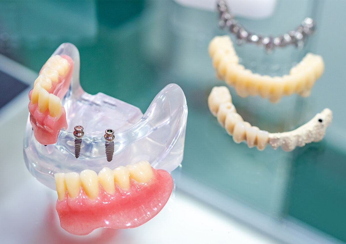 Dentist Explain Big Advances For Dental Implants In Ballwin Area