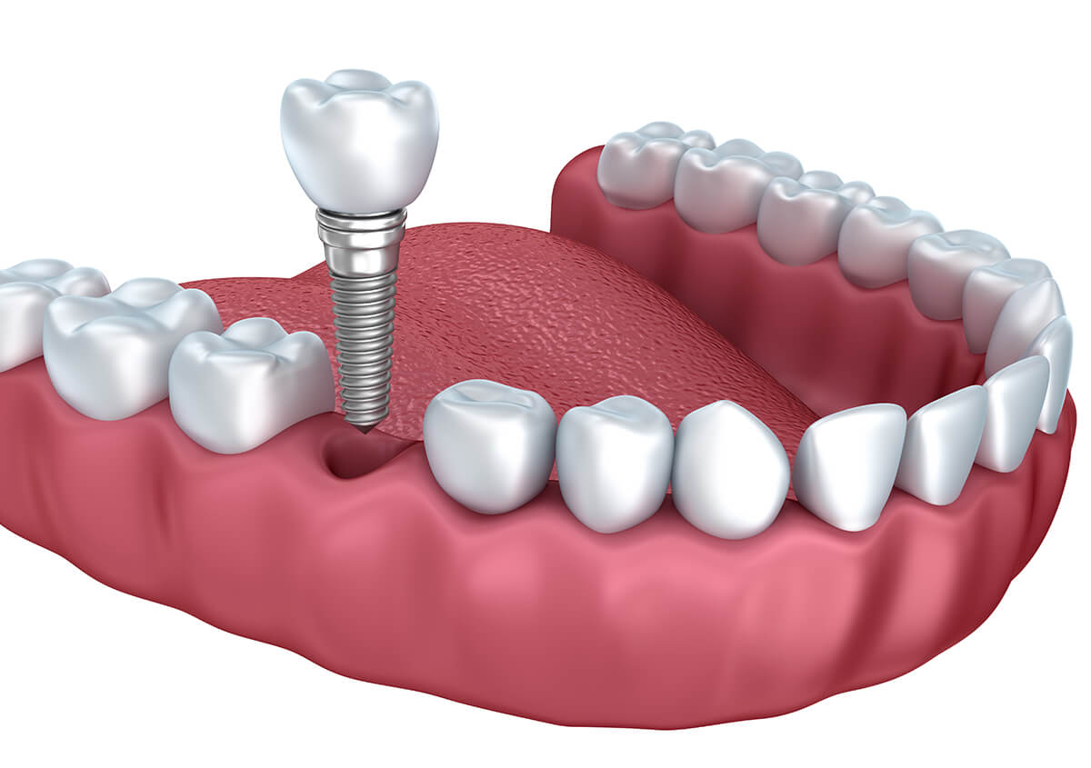 Dentist That Does Implants in Ballwin MO Area
